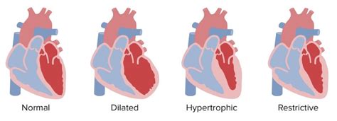 Cardiomyopathy: Causes, Types, Symptoms & Treatment Options