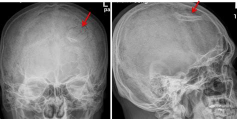 Depressed skull fracture – Radiology Cases