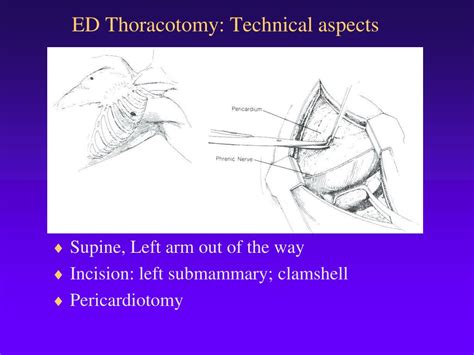 Clamshell Thoracotomy