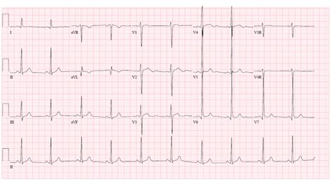 An Adolescent With a Murmur and an Unusual ECG - American College of ...