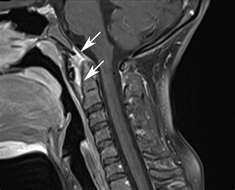 Atlantoaxial Instability