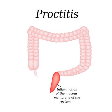 Rectum function | anatomy, disorders, cancer prevention, pictures