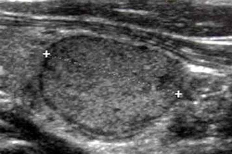 Thyroid Follicular Adenoma