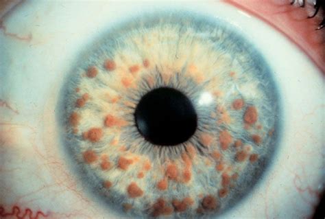 lisch nodules - Google Search NF 1 | Neurofibromatosis type 1, Optometry, Eyes