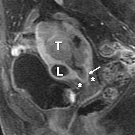 MRI of Malignant Neoplasms of the Uterine Corpus and Cervix | AJR