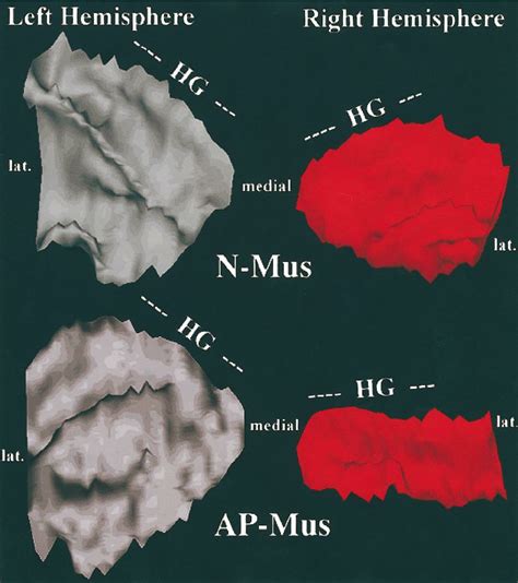 Musicians with absolute (perfect) pitch have a 'pruned' planum temporale in their right cerebral ...