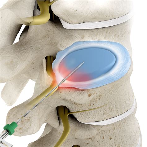 Disc decompression | Interventional Spine