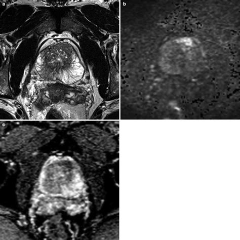 Fig. 11.10, [(a–c) PI-RADS 4 lesion in...]. - Diseases of the Abdomen and Pelvis 2018-2021 ...