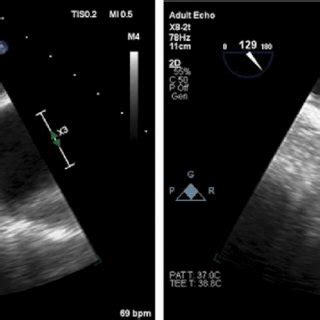 Left atrial appendage morphology as seen on transesophageal ...