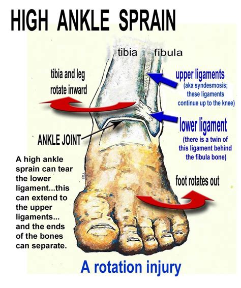 The 25+ best Ankle sprain recovery ideas on Pinterest | Ankle pain ...