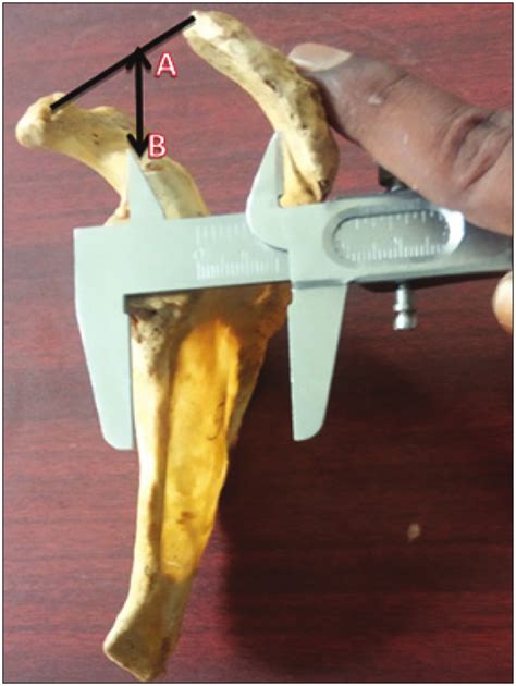 (A) ML diameter from the posterior rim of the glenoid cavity to the... | Download Scientific Diagram