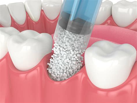 Bone Grafting - NKC Dental