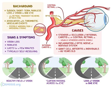 Amaurosis Fugax: What is it, Causes and More | Osmosis