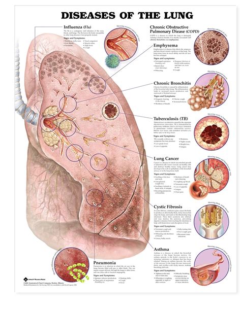 Diseases of the Lung Chart - MedWest Medical Supplies