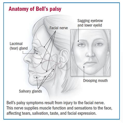 Bell's palsy overview - Harvard Health