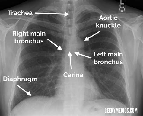 Assessing Nasogastric (NG) Tube Placement | Geeky Medics