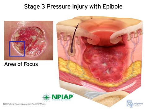 Pressure Injury Stages - National Pressure Ulcer Advisory Panel