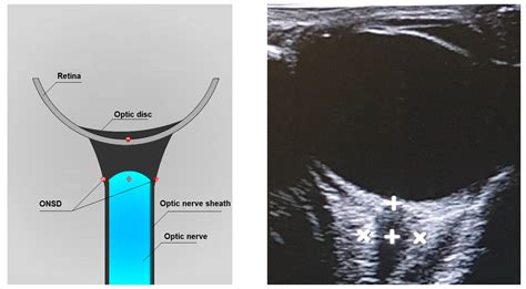 Optic Nerve Sheath Diameter