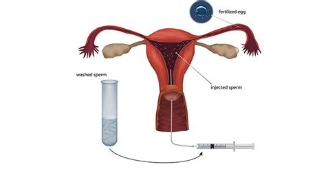 Artificial Insemination