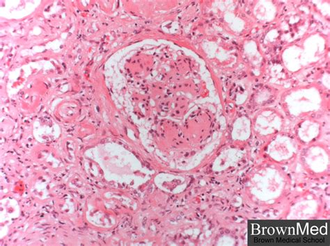 Nodular glomerulosclerosis