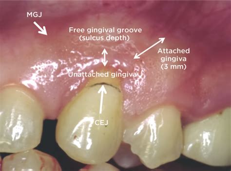 Miller Classification of Marginal Tissue Recession Revisited After 35 ...