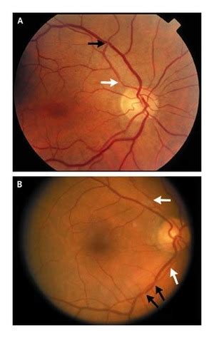 Hypertensive Retinopathy | NEJM