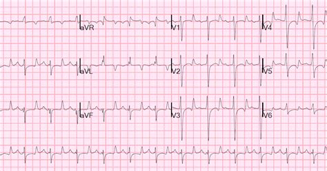 Dr. Smith's ECG Blog: Found comatose with prehospital ECG showing ...