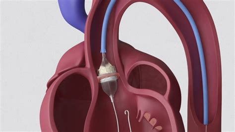 Transcatheter Aortic Valve Implantation (TAVI) – Explain My Procedure