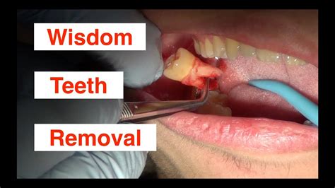 Wisdom Teeth Removal - YouTube