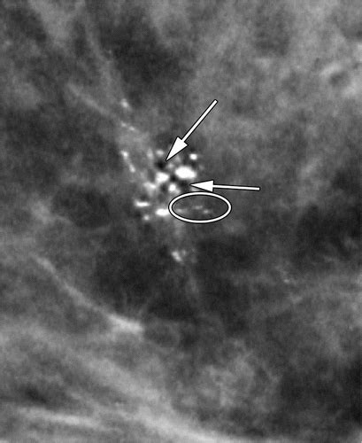 Microcalcifications Detected at Screening Mammography: Synthetic Mammography and Digital Breast ...