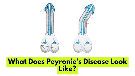 What Does Peyronie’s Disease Look Like?