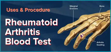 What is Rheumatoid Arthritis Blood Test - Uses, Procedure and Cost