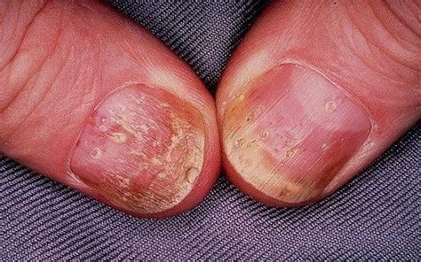 Nail psoriasis