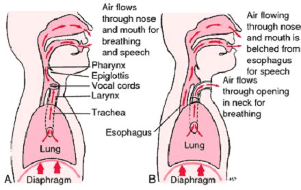 Medical Treatment Pictures-for Better Understanding: Total Laryngectomy Surgery: Before & After ...