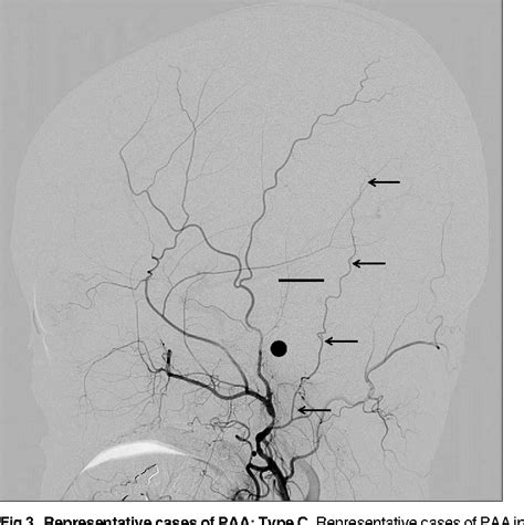 Figure 1 from Novel Classification of the Posterior Auricular Artery Based on Angiographical ...