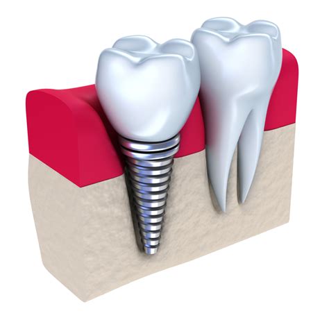 Astoria Dentist Answers: What is a Dental Implant? | Astoria, NY