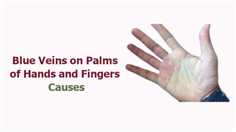 Blue Veins on Palms of Hands and Fingers Causes