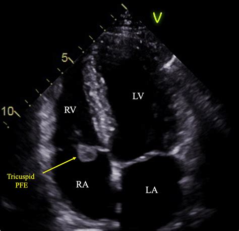 Cureus | Discovery of Tricuspid Fibroelastoma on Echocardiography