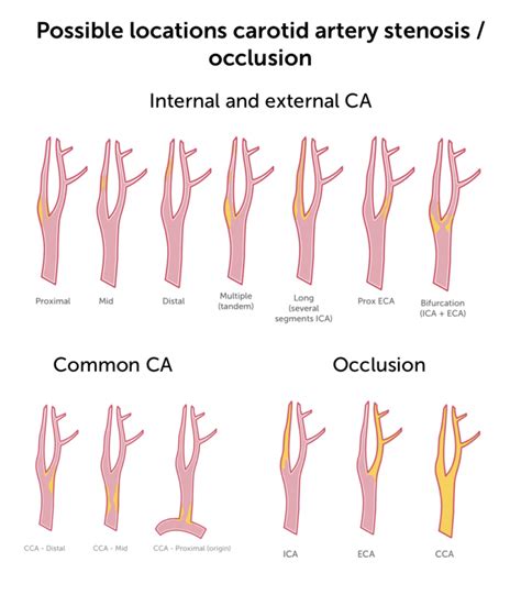 11. Carotid Artery Stenosis Part 1: B mode and Color flow | 123sonography