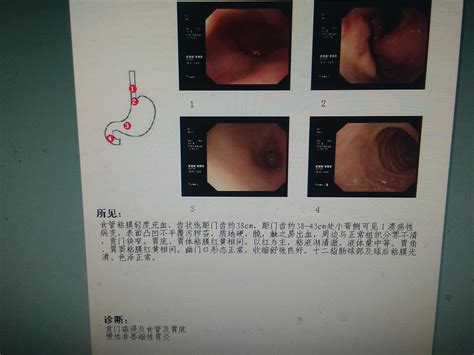 胃溃疡 - 病例中心(诊疗助手) - 爱爱医医学网