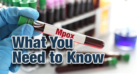 What You Should Know About Mpox - Mega Doctor News