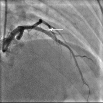 Coronary angiogram showing LAD coronary artery post-angioplasty. | Download Scientific Diagram