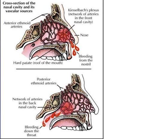 Nosebleeds – what to do when your nose bleeds | The Chestermere Anchor Weekly