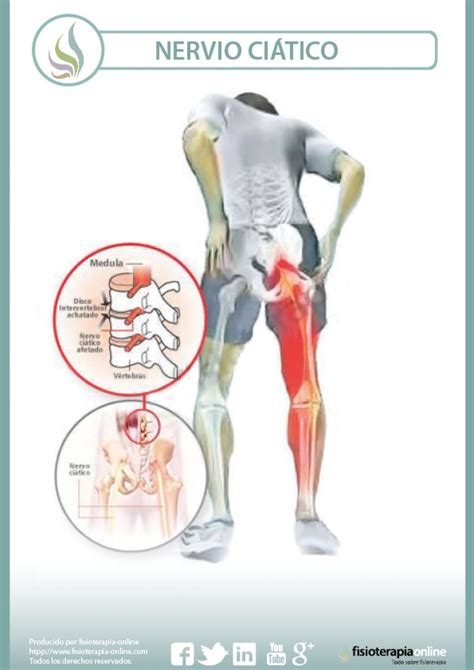 Síndrome piramidal y atrapamiento del nervio ciático, todo lo que ...