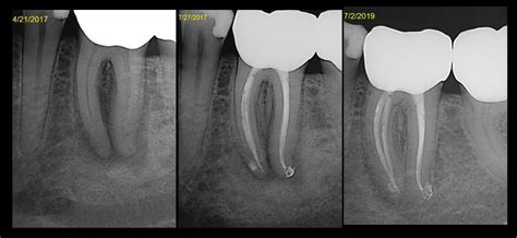 Bilateral Endo-Perio Cases – The Endo Fix