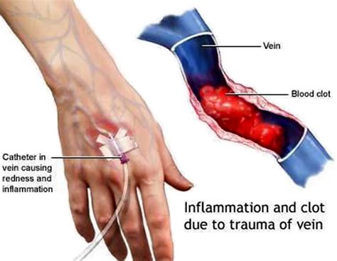 About Health: Phlebitis