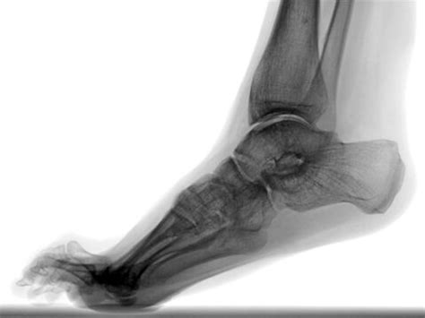 Equinus Deformity - Physiopedia