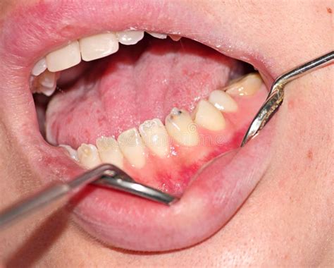 Hypoplasia of tooth enamel stock image. Image of illness - 49221537