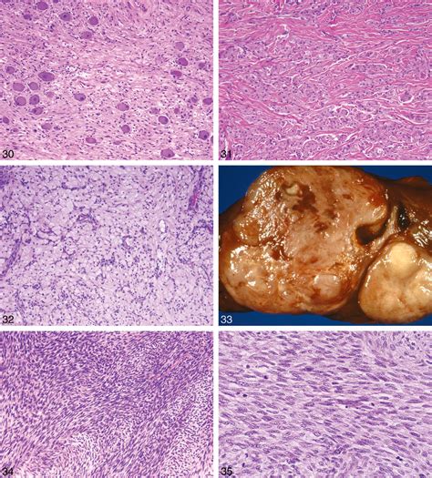 Neurogenic Tumors of Soft Tissue | Semantic Scholar