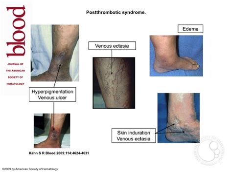 Postthrombotic syndrome